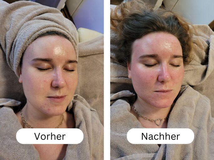 Vorher-Nachher-Ergebnis von meinem ersten Hydrafacial | © myself/Eva Nunberger