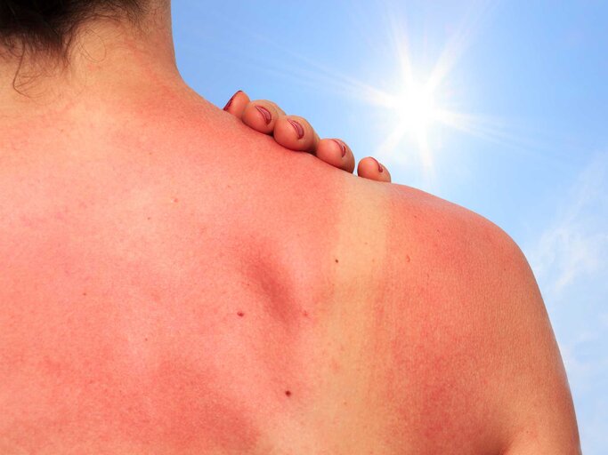 Frau steht mit Sonnenbrand am Rücken in der Sonne und hält sich die Schulter. | © Adobe Stock/juefraphoto